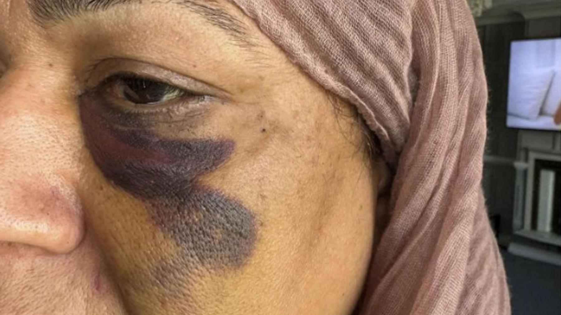 A close up photo of a woman's face. She has a dark bruise unde her eye and wears pale pink headscarf