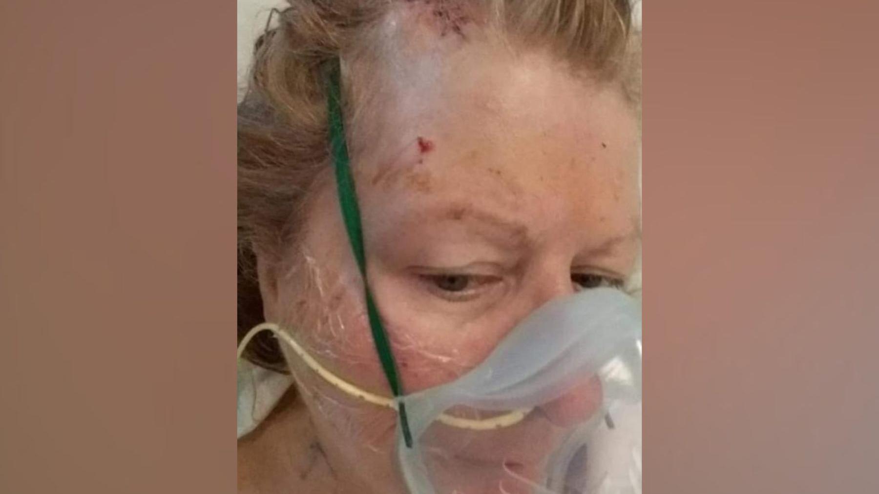 Wendy Swain in hospital. There are cuts in her head and she is wearing a plastic, opaque mask over her mouth. She has short, dark hair, pulled back behind her head.