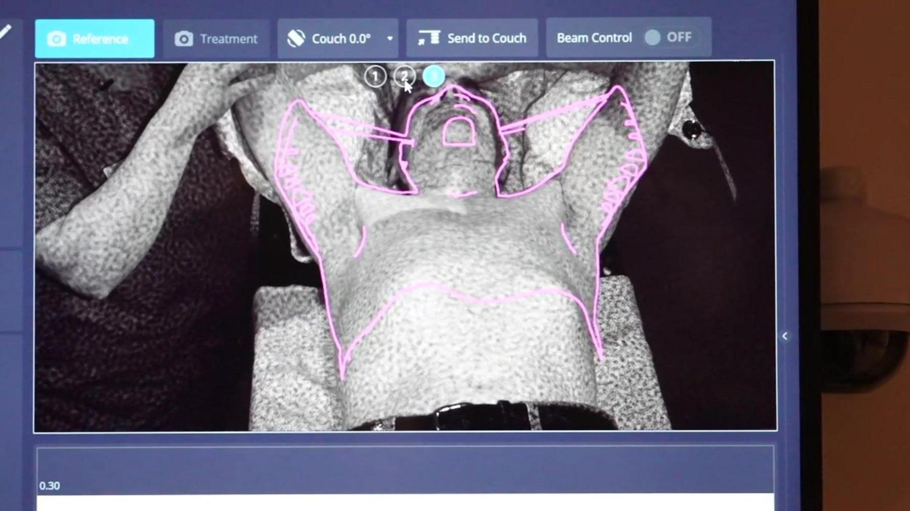 A screen showing a cancer patient with his arms above his head and digital lines showing the outline of his upper body