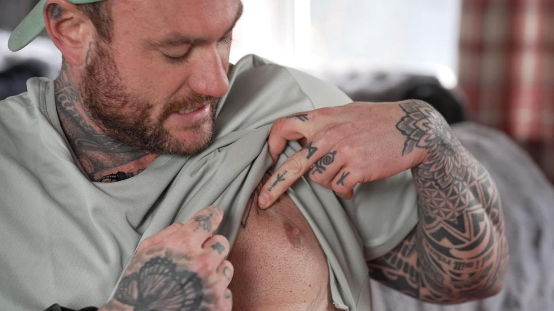 Tom Powell shows his scars after having breast tissue removed