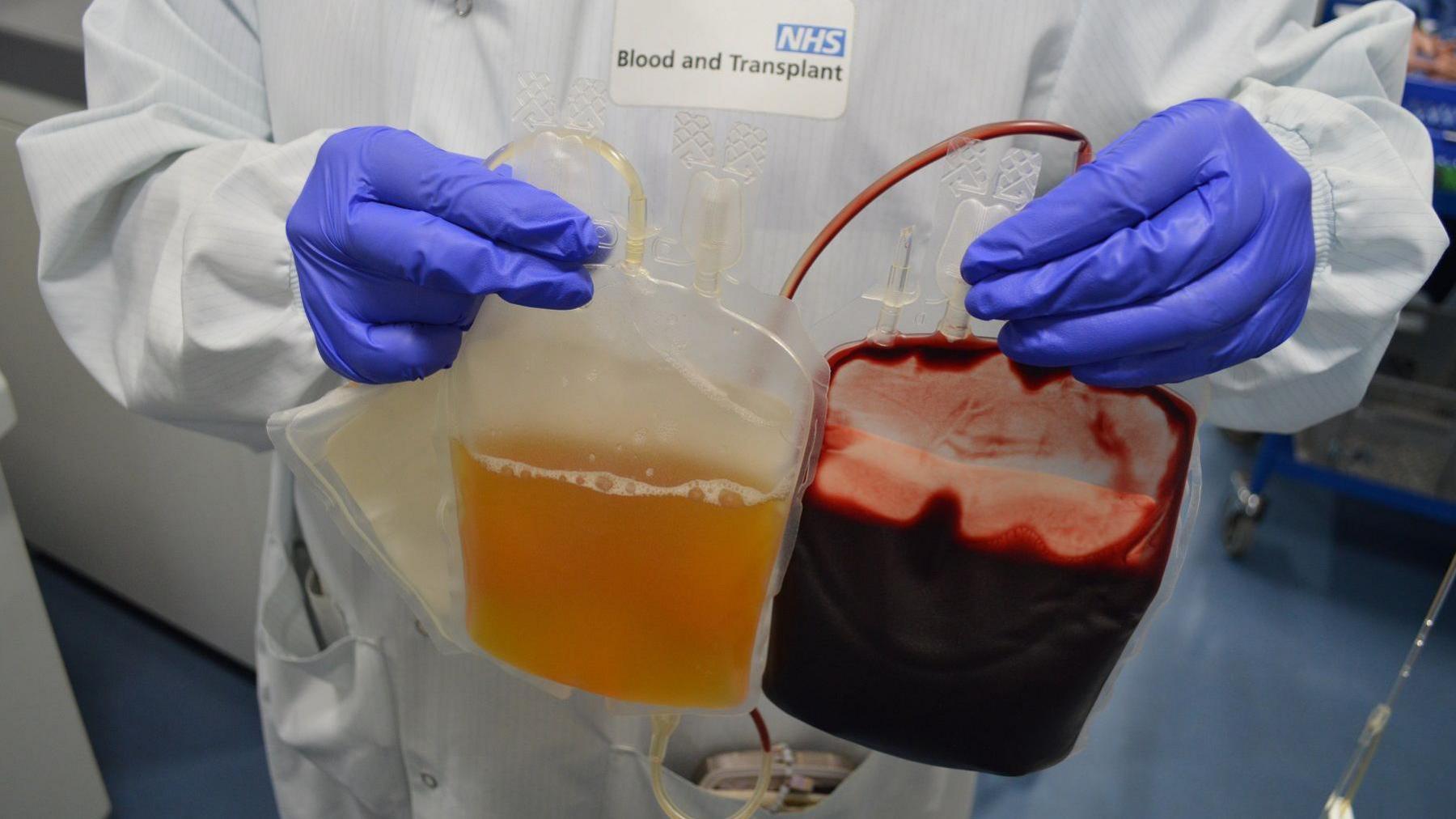 A medical professional holding two bags, showing plasma separated out of red blood cells.