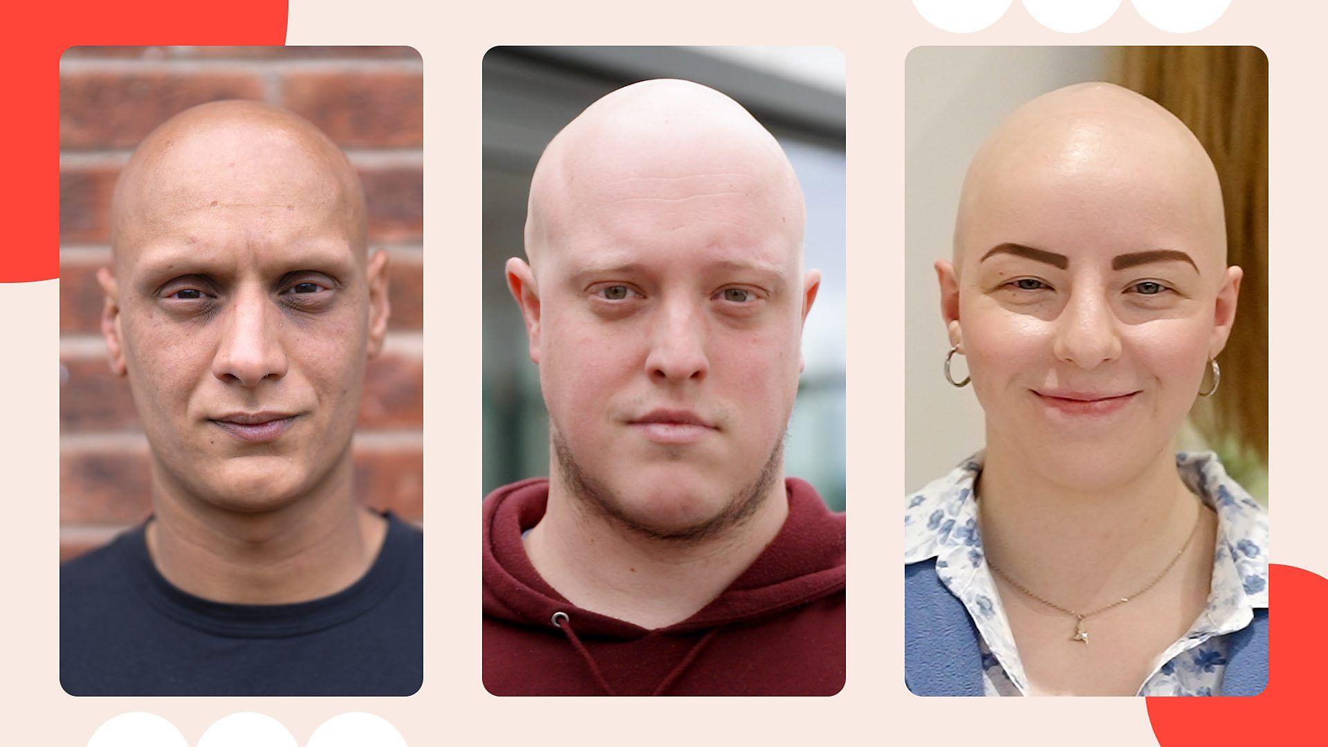 headshots of 3 people with alopecia