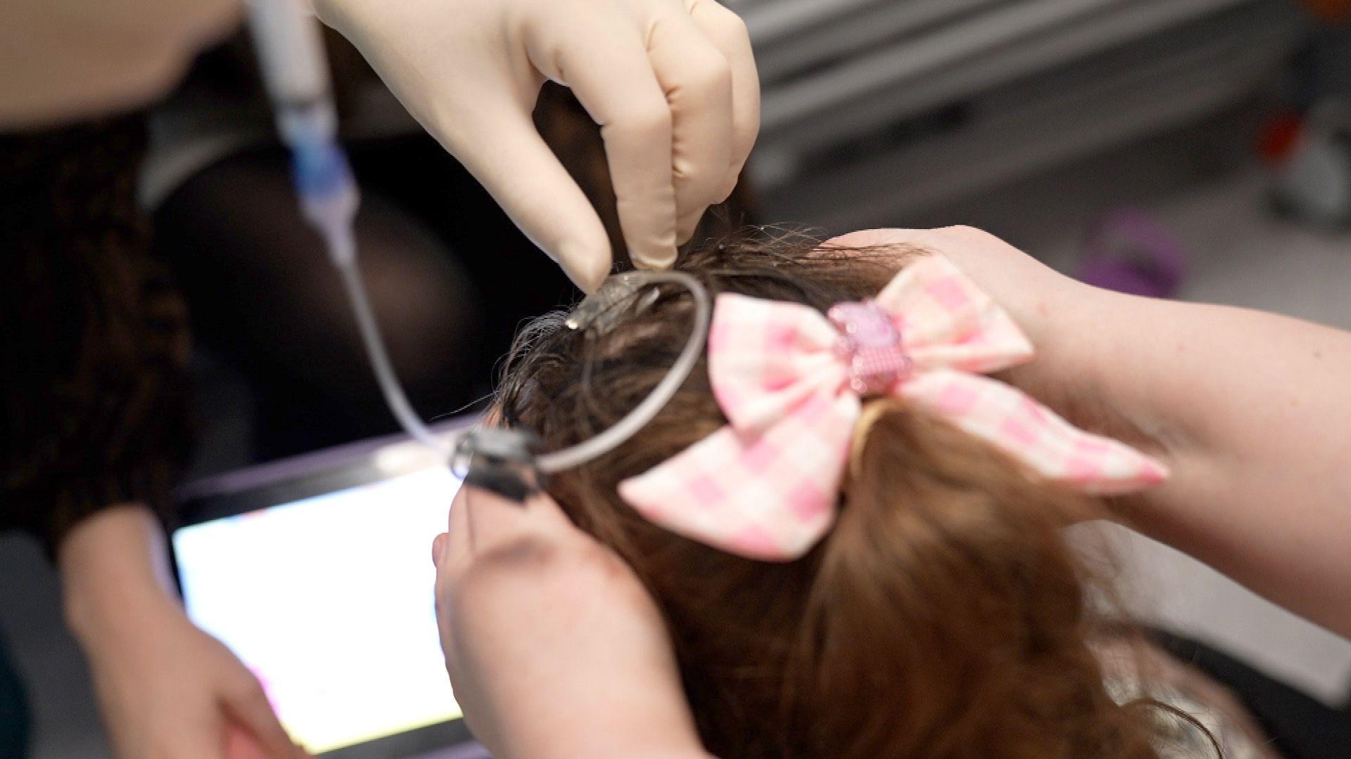 A close-up of a clear plastic tube of liquid being connected to a girl's head. Dark brown hair can be seen tied back in a pink bow and a hand in a white glove connecting the tube.