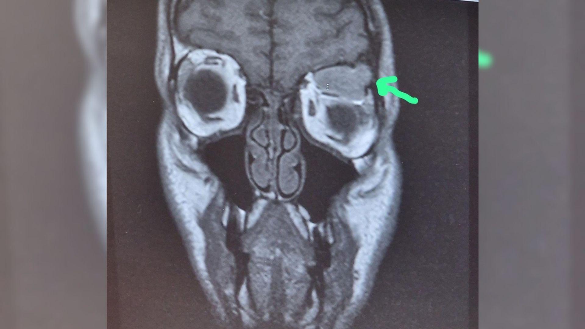 An MRI scan of Stephen Lewis' head showing a tumour between the eye and brain.