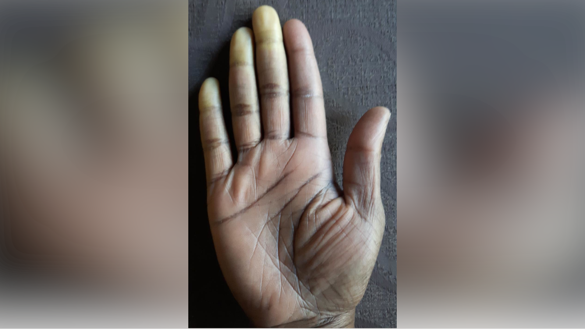 A generic view of a person's hand who has Raynaud's disease. Three of their fingers have slightly lost any colour due to the disease.