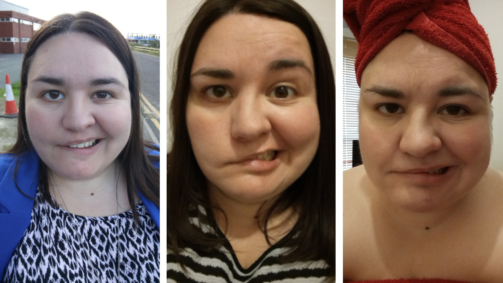 Three selfies of Amy - a woman with long brown hair and a facial droop. The left side of her mouth is open and the right side is lower and closed.