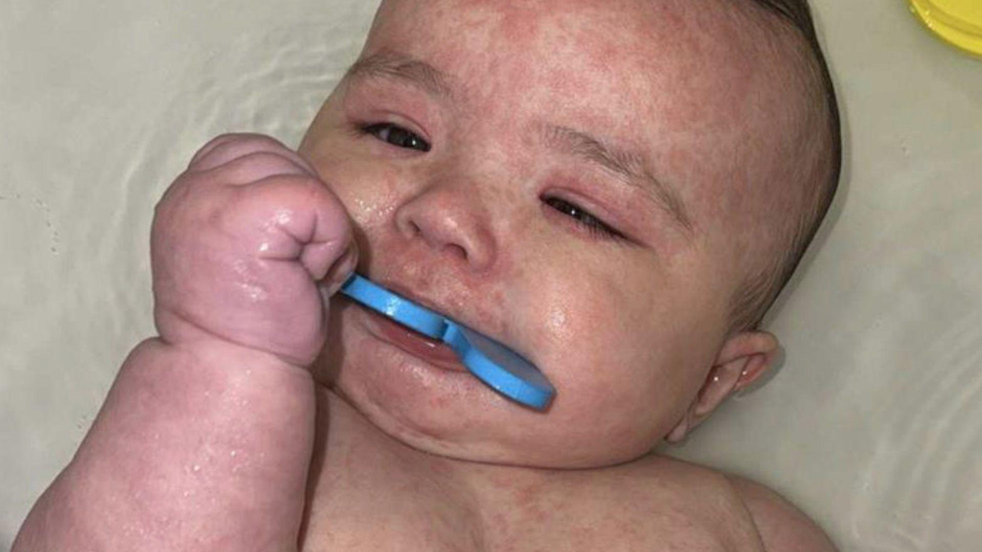 A photo of Kimie with a visible red rash on her body, a common symptom of measles.