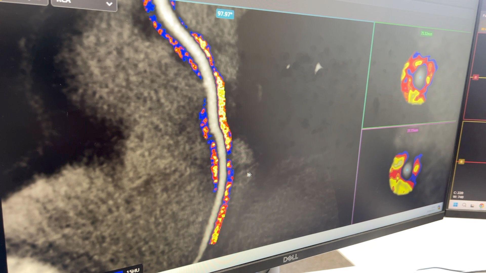 A scan showing inflammation of the heart