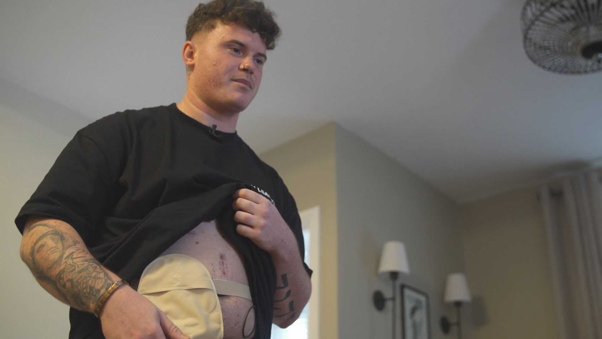 Ollie'n dangos ei fag stoma yn y rhaglen