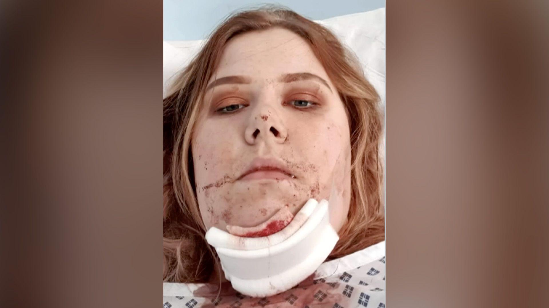 A 2019 photo of Jade lying in a hospital bed shortly after her accident. She has long, light brown hair and are wearing a white medical neck brace that extends from the lower face to the upper chest. There is visible redness or blood around the lips and chin area, suggesting recent trauma or injury. She is resting on white bedding, and the background features a light blue wall, contributing to the clinical setting.