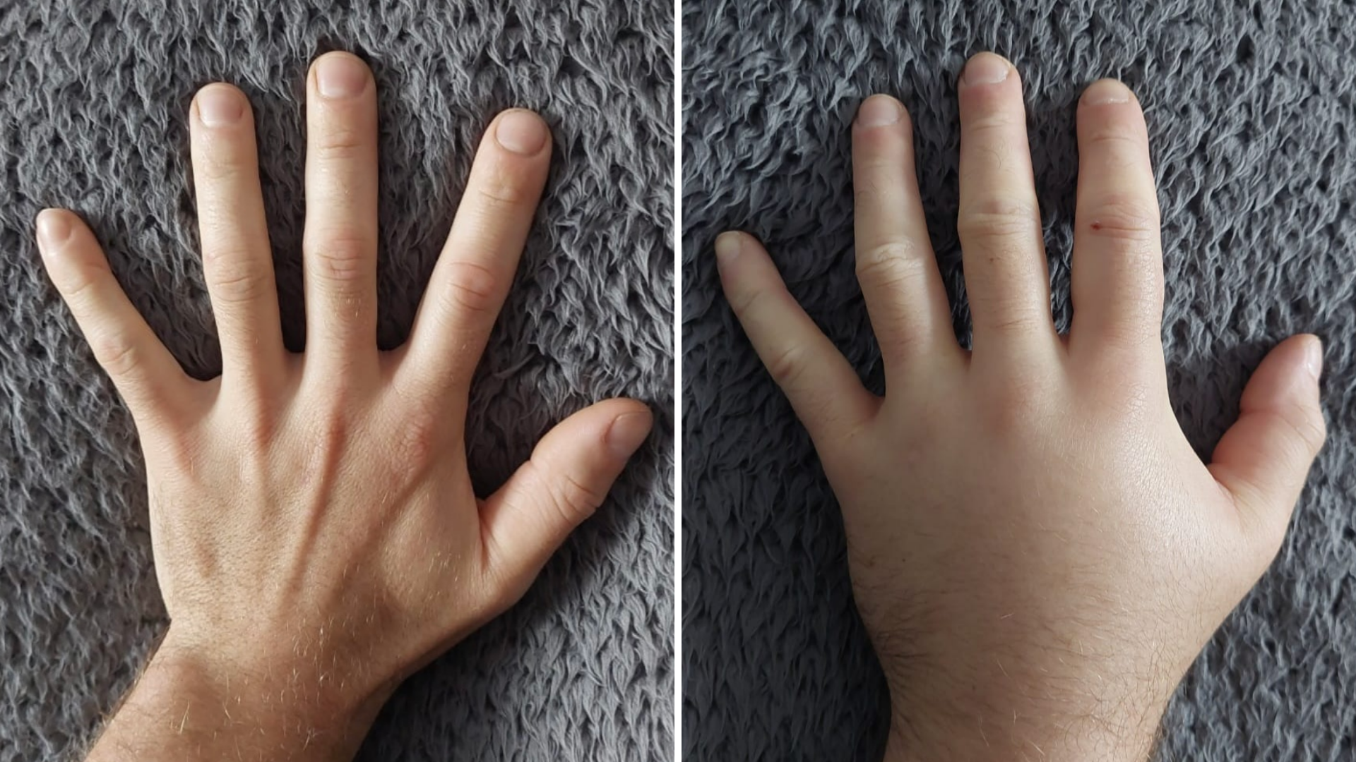 Side-by-side comparison of two hands placed palm-down on a grey blanket. The hand on the left appears slimmer and the right appears fuller and puffier.