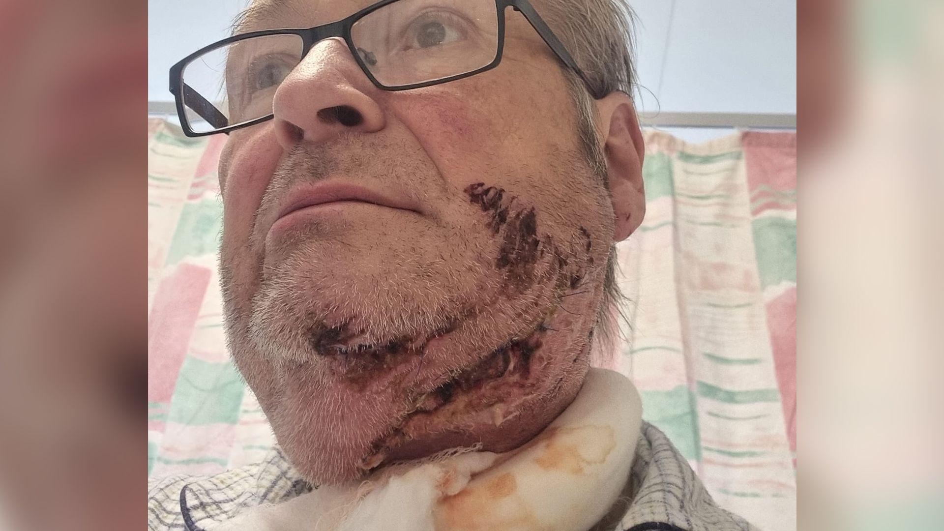Chainsaw accident injury on Christopher York in bed in hospital