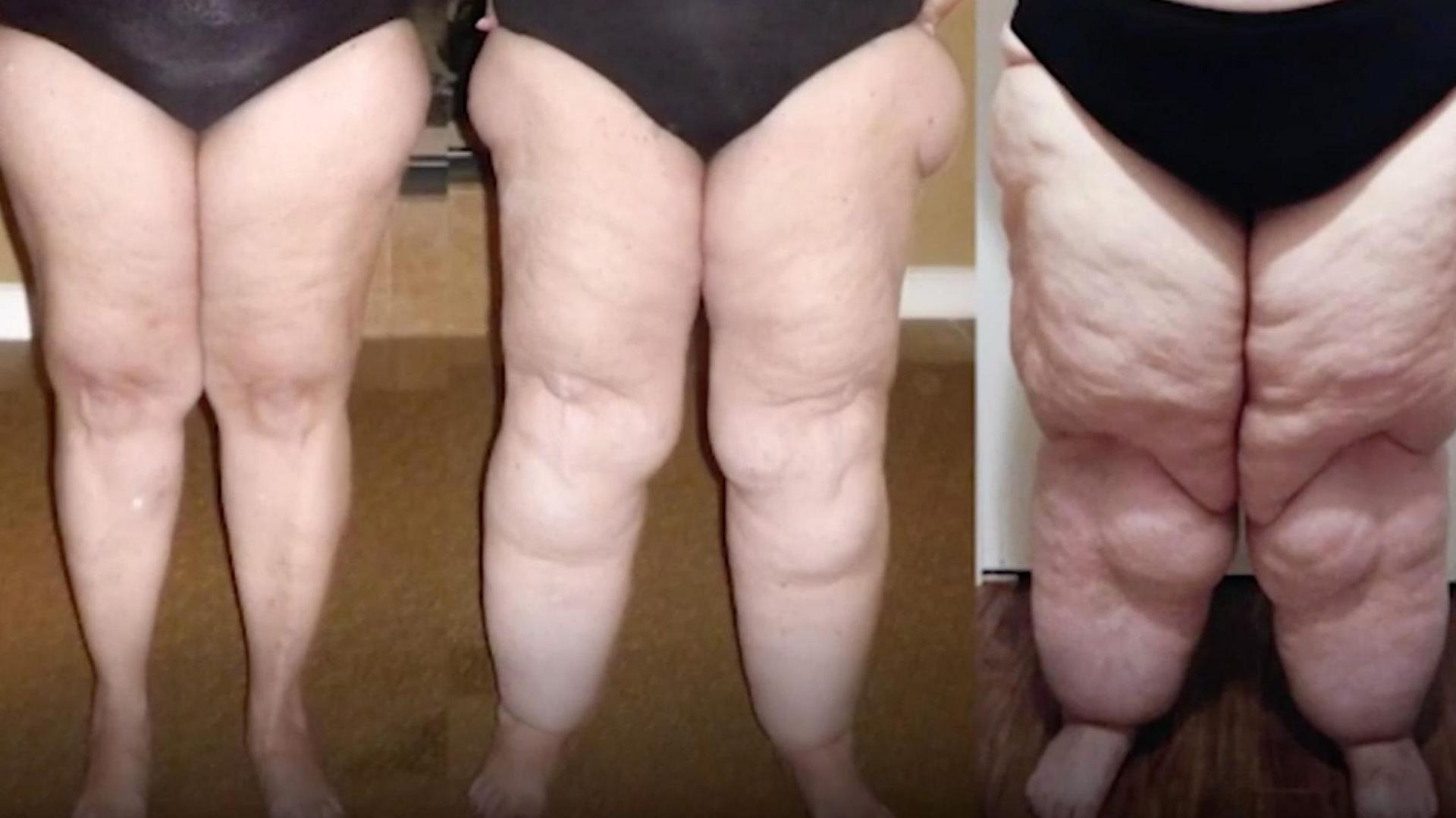 Enghreifftiau o goesau menywod sy'n dioddef o lipoedema