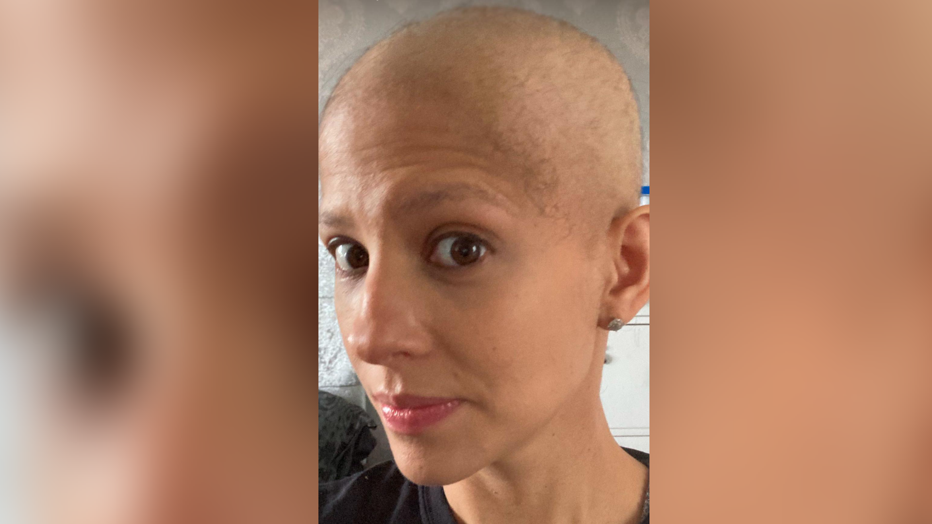 Anastasia, who has no hair in this photo after treatment for breast cancer, is looking at the camera