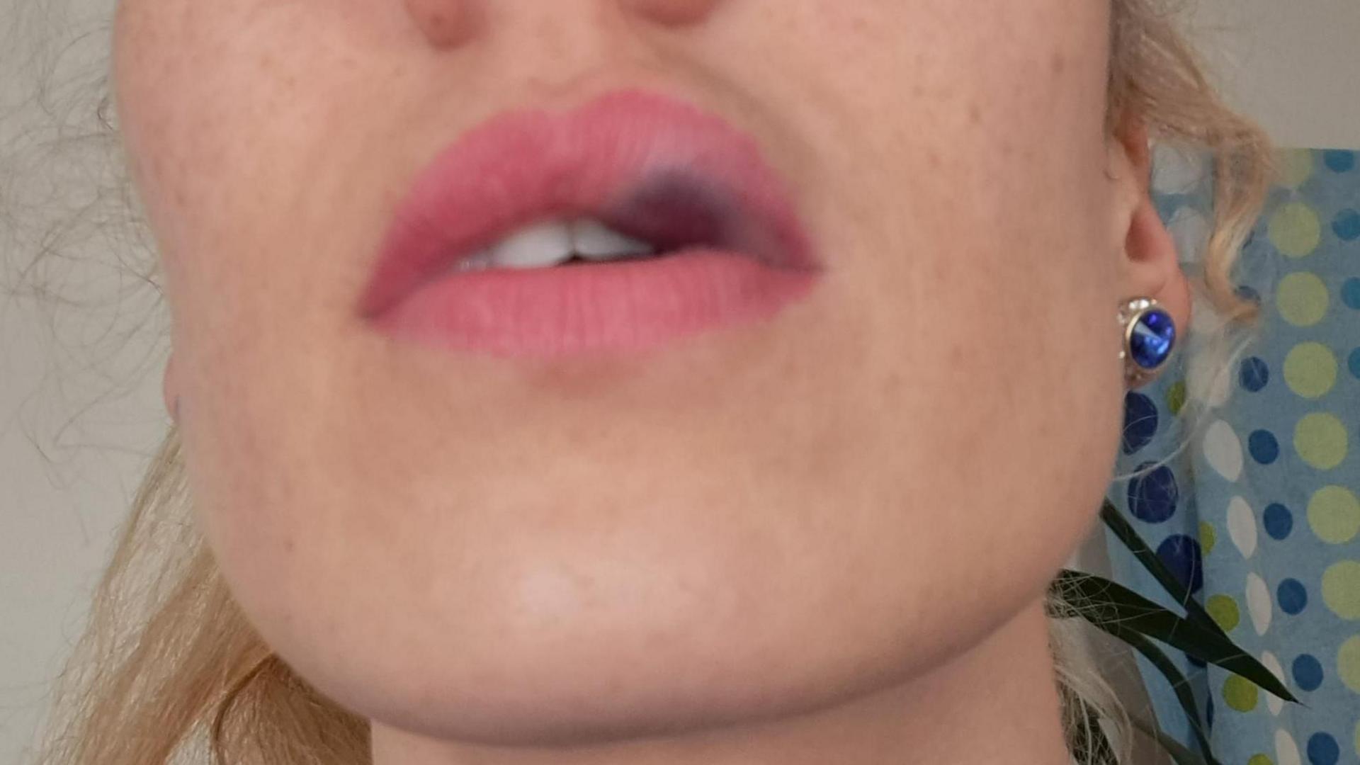 A close up selfie of Ms Jucaite's lips after the procedure. One side is swelled up and a purplish colour.