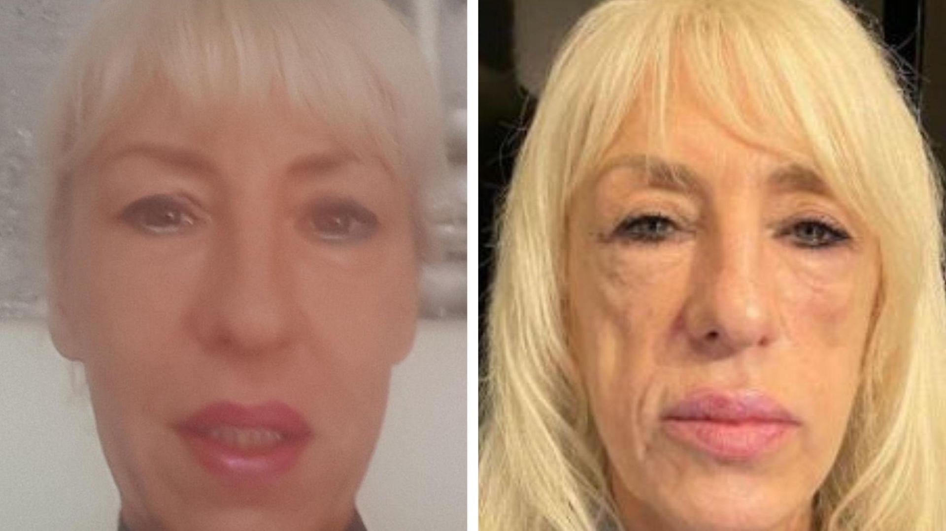 A composite image of Andrea before and after her treatments. On the left she has white-blonde hair, striking blue eyes and red lipstick with eye liner and make-up on. On the right, he face looks gaunt and he cheeks are thin. She has lost volume in her lips. 