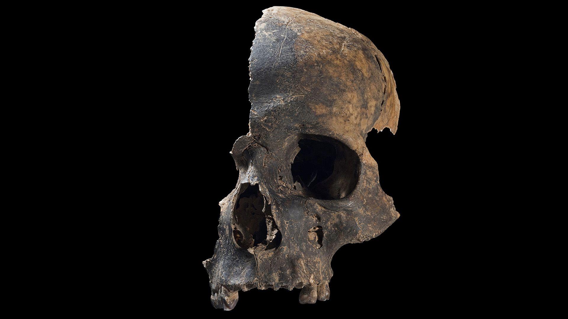 Partial remains of a human skull showing signs of having suffered devastating injuries in the Bronze Age.