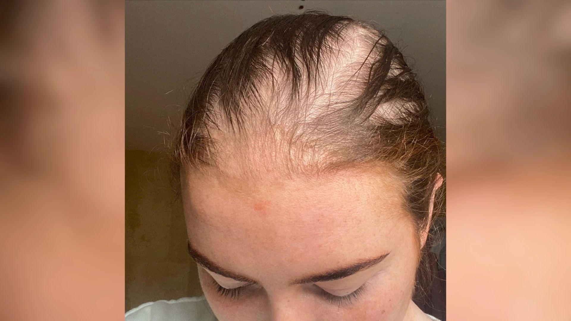 Olivia showing her hair loss on her scalp