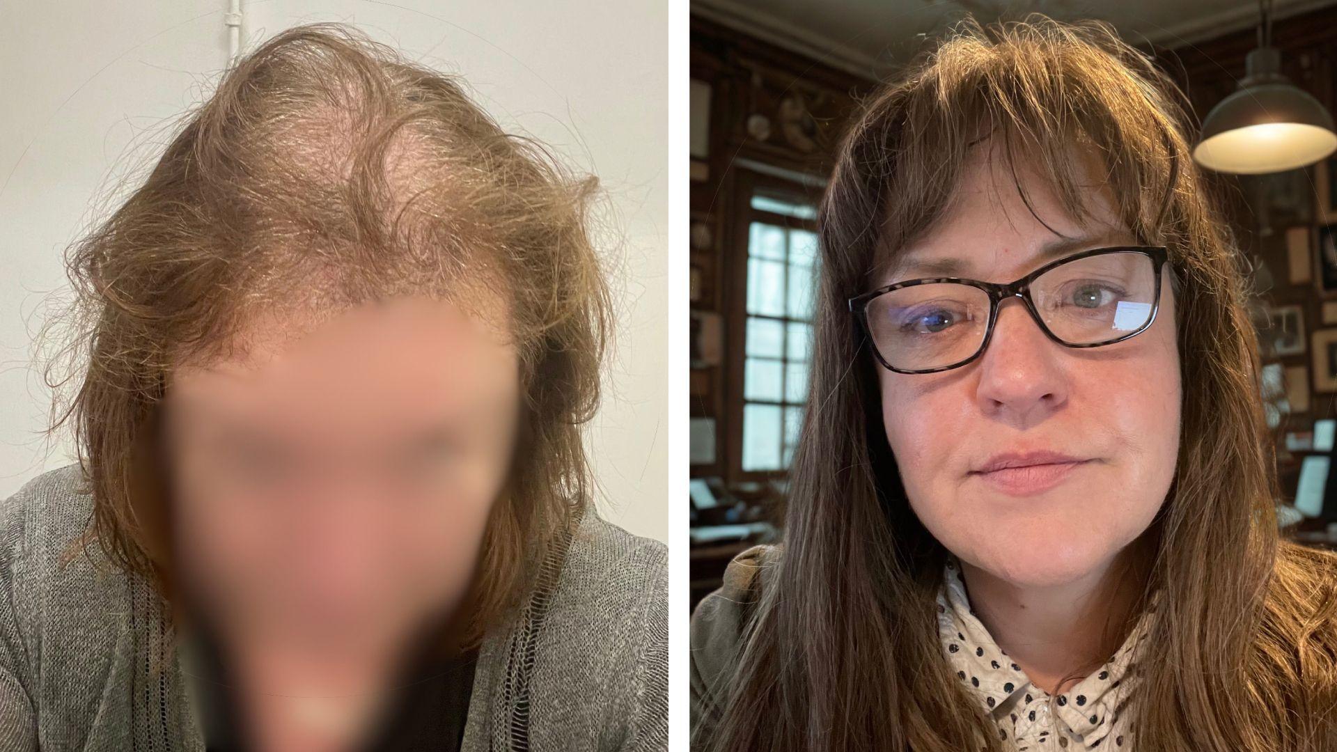 Two headshots of the same woman. In the left image, she has short, thinning brown hair. She is wearing a black top, a greay cardigan and her face is blurred out. She is standing in front of a plain white wall. In the right image, she has long, thick, brown hair. She is wearing glasses, a beige top with black spots and a green blazer. She is in a room covered in photo frames, a large window and a ceiling lamp.