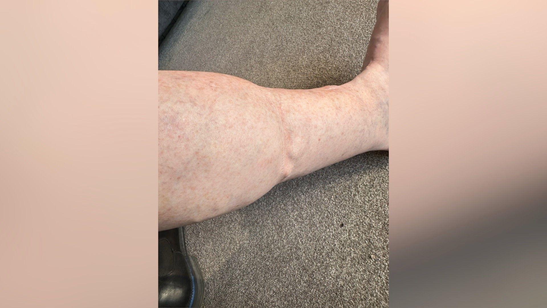 This is a picture of a swollen leg showing a classic wine glass shape that can be common with heart failure. It shows the calf portion of the leg.