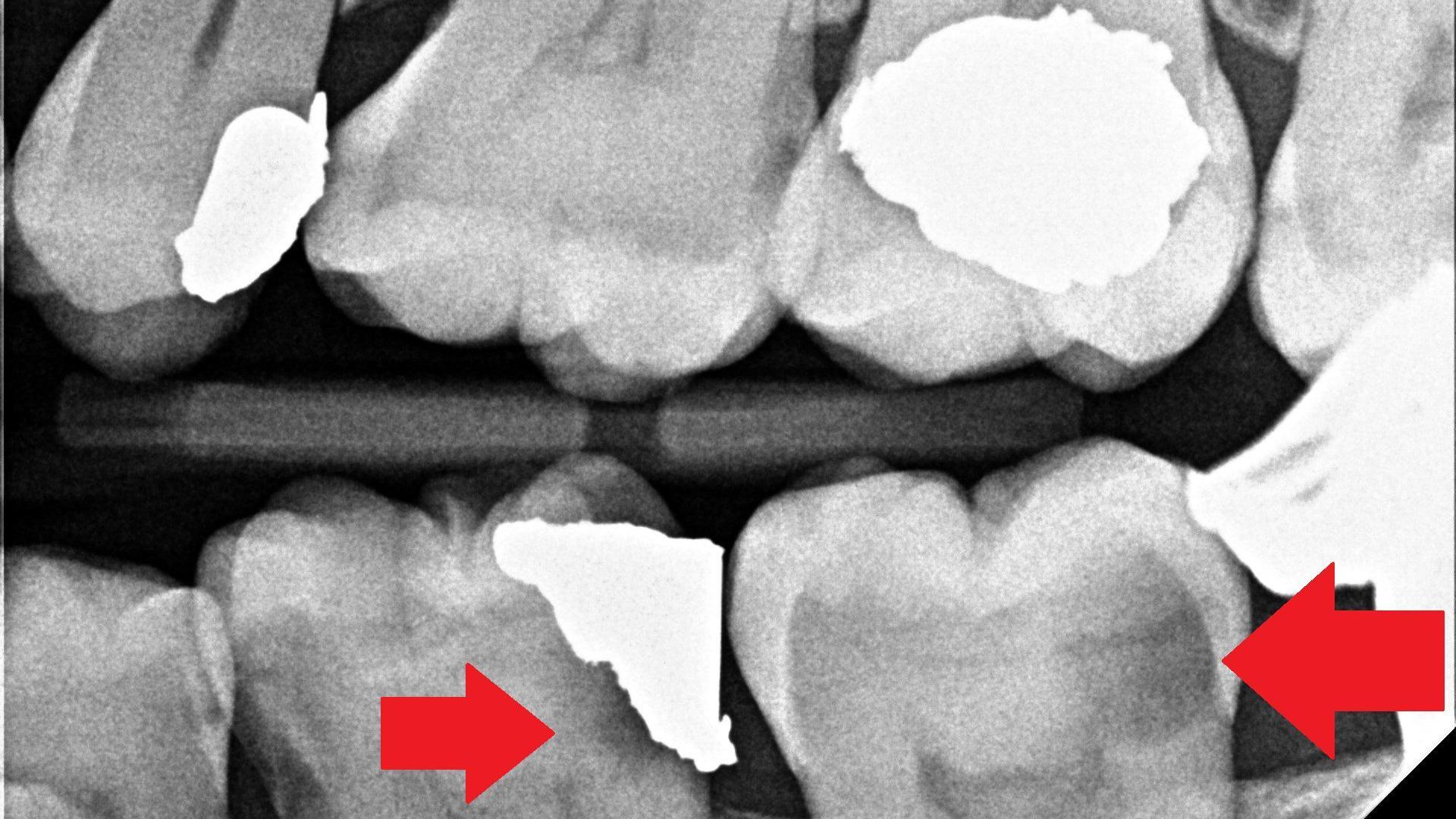 An x-ray image of Mr Littleover's teeth, with arrows pointing to areas of decay