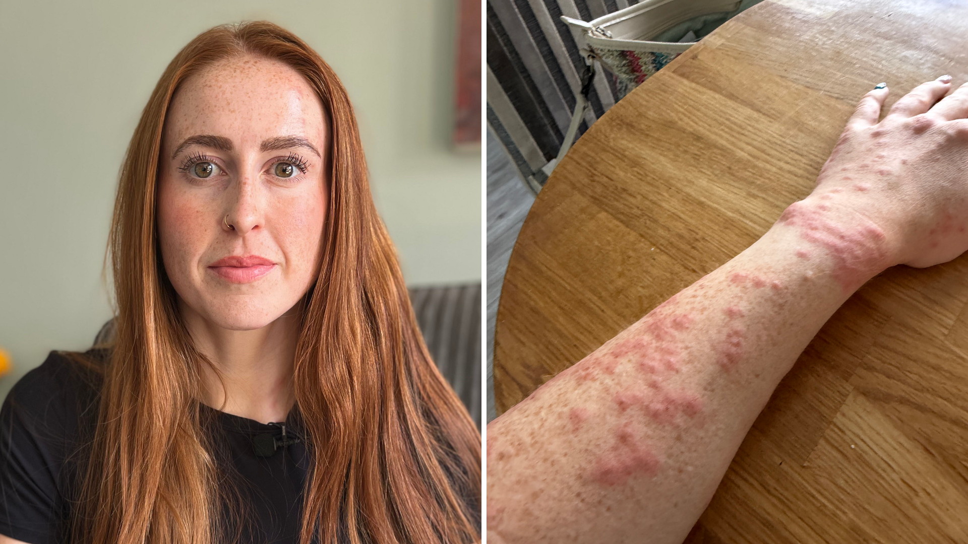 A composite of two pictures of Hannah Stephenson. The one on the left is a head and shoulders picture of Hannah sitting on a grey sofa in a living room. She is looking directly at the camera and is wearing a black short-sleeved T-shirt. On the right is a picture of her arm, which has red raised bites all over it, which she believes to be from bed bugs.