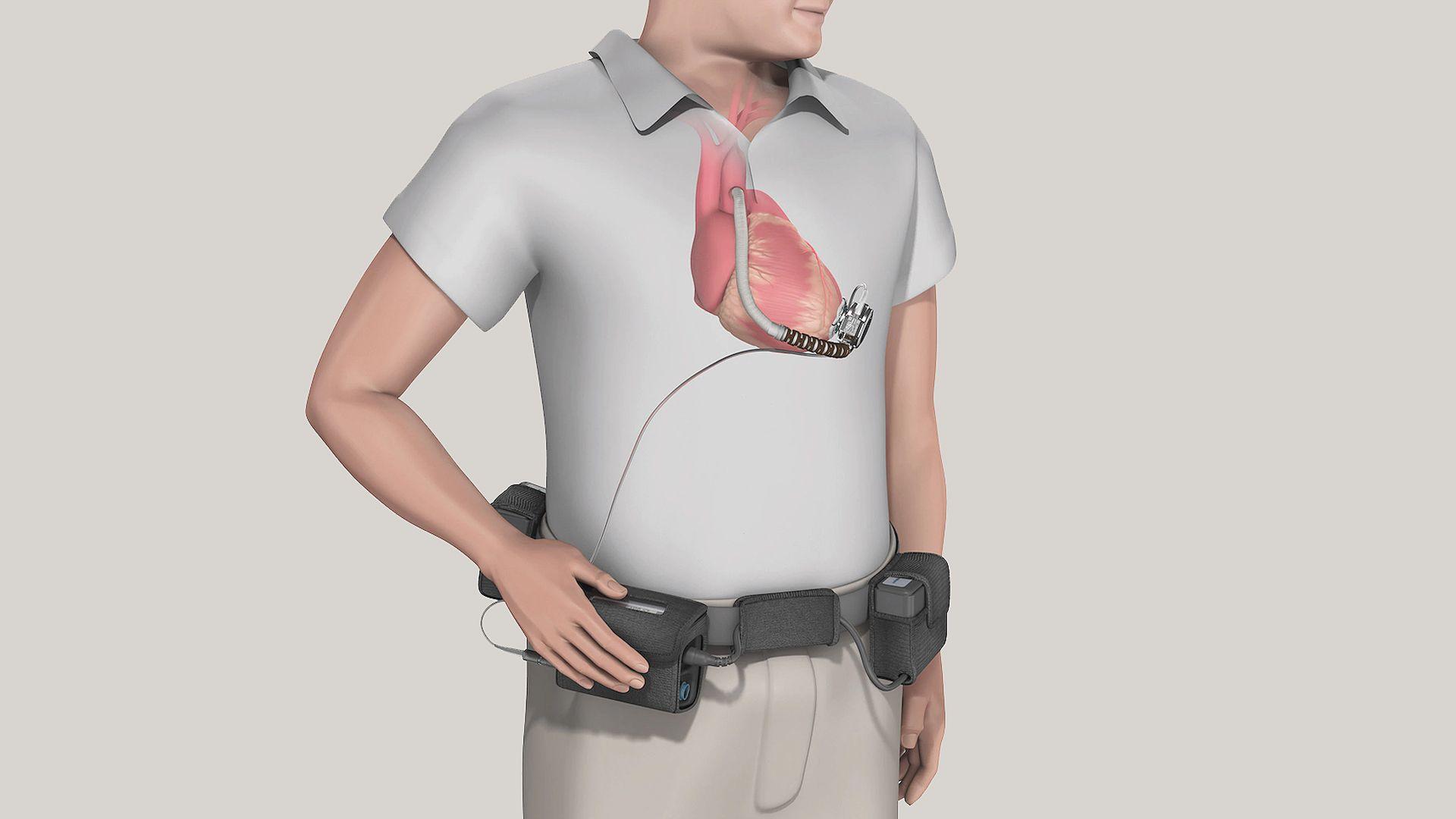 An illustration of a man in a white T-shirt wearing a black belt holding four small black devices with wires protruding; higher up, we see a scan of his heart, from which a small pump with a tube emerges. A wire links the device and one of the black devices on his belt.