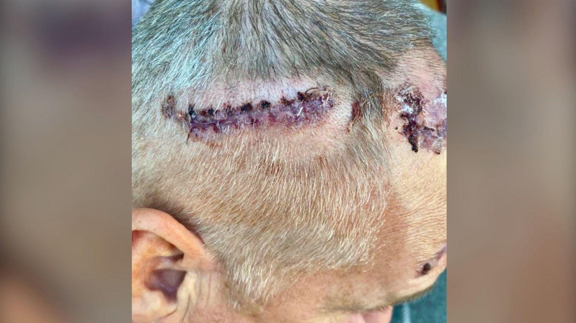 Kevin's head shaved after surgery. You can see the stitches in his skull where he had the operation to implant the wires into his brain.   