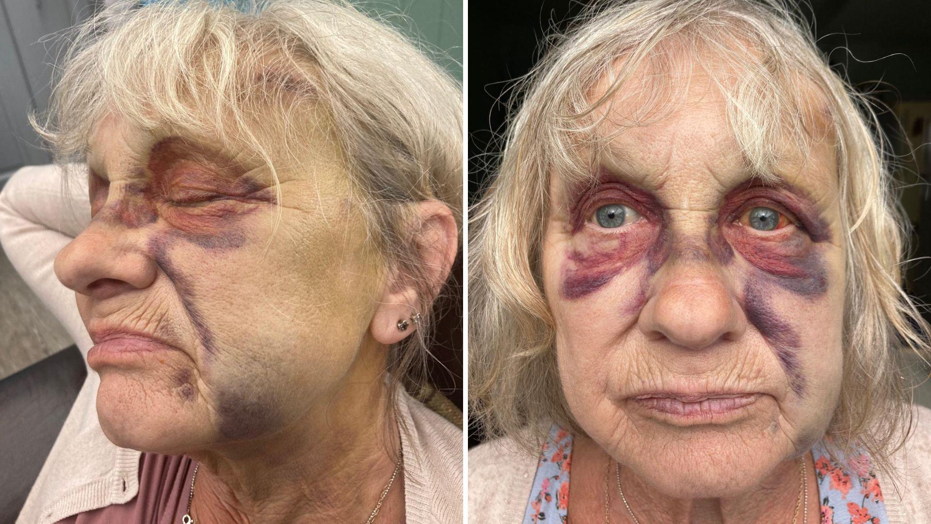 Two views of a woman with severe bruising to the face in hospital
