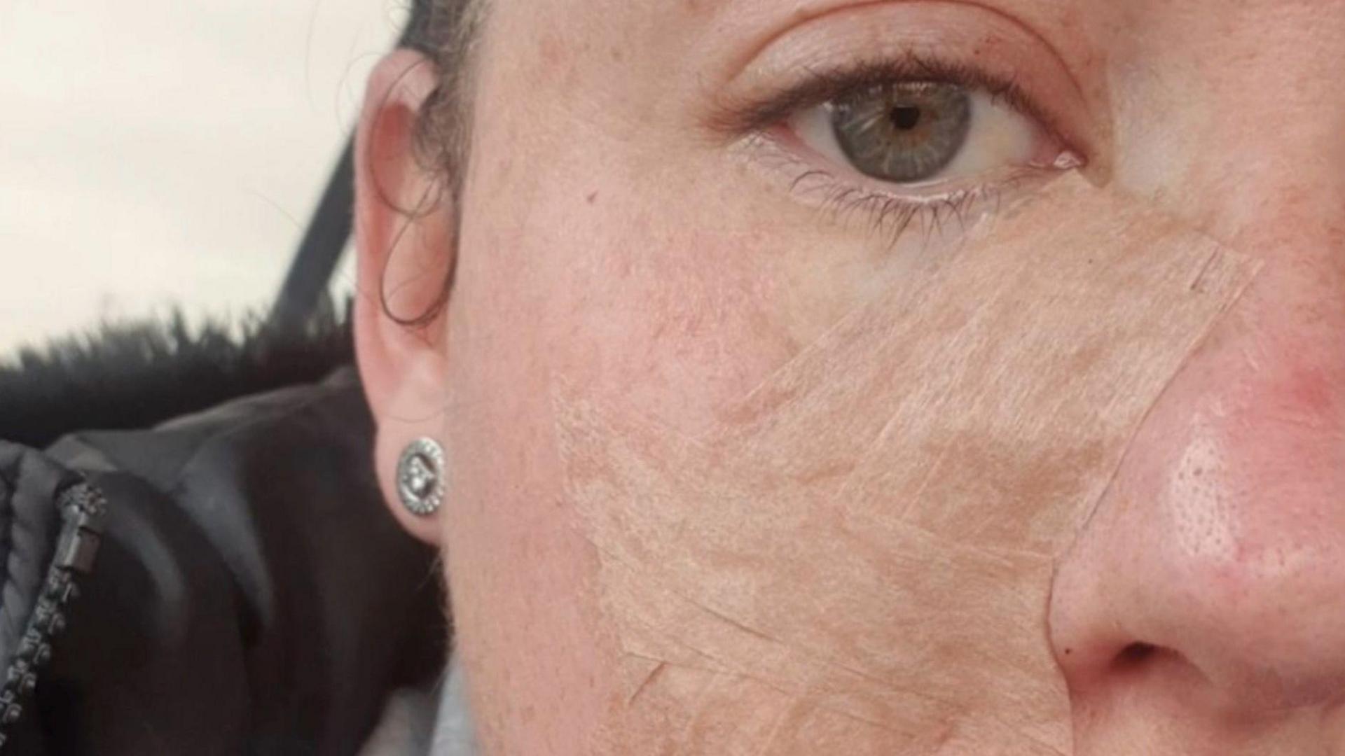 Close up of the right side of Levi-Mariah Verrall's face showing skars under the eye after skin cancer surgery