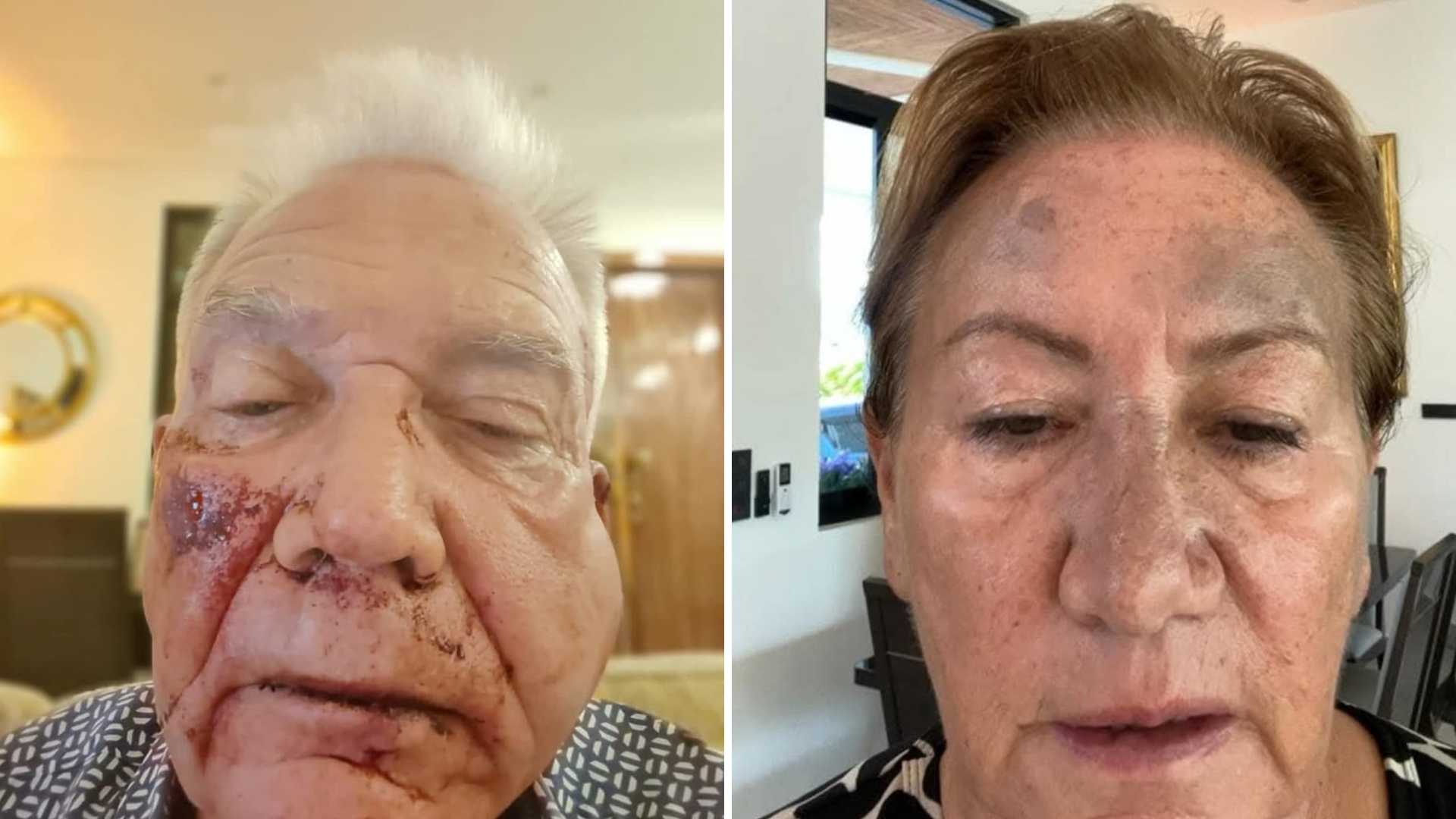 Two close-up photos of Desmond and Mary following the attack. Desmond's face is covered in blood and his cheek is swollen. Mary's face is covered in brusies.