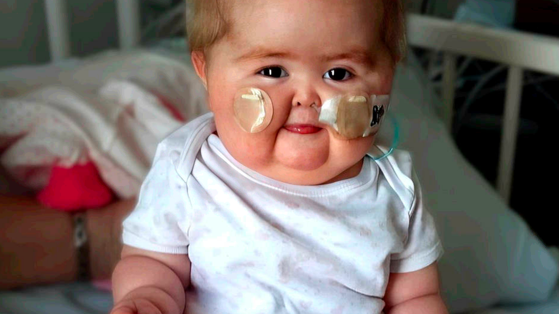 Jorgie Stanton-Watts in a crib at Kettering General Hospital. The photo shows Jorgie with a nasal tube and monitoring devices on both cheeks. She had a condition that made her face appear puffy. She is wearing a white bodysuit.