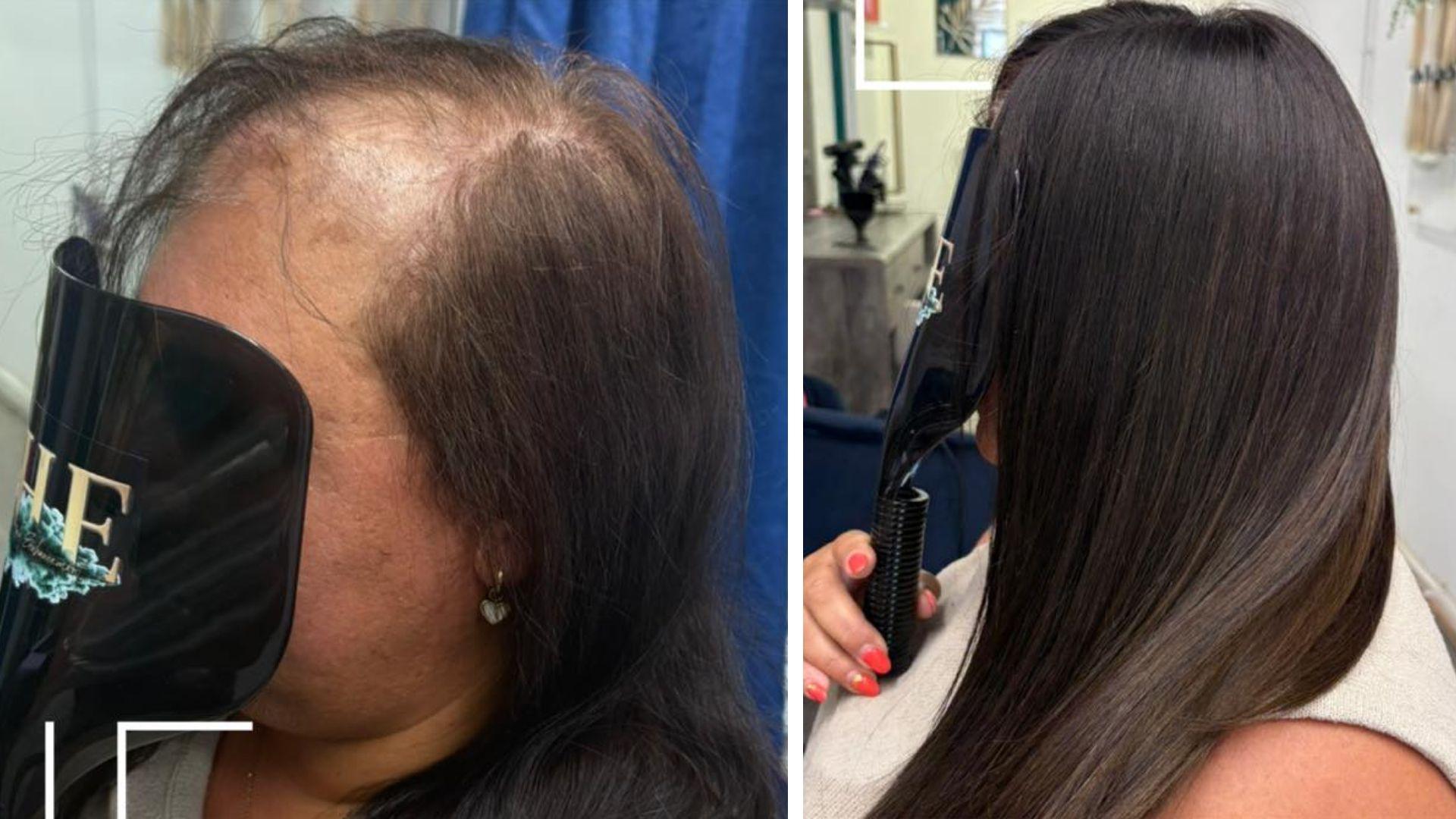 Two images. Both close ups of a woman's hair with her face blurred. In both images, the woman is wearing a cream short-sleeved top. In the left image, the woman's hair is very thin around the side parting revealing a large bald patch. In the right image, the woman's hair is long, thick and dark. The woman holds a black cover to her face in both images with a hairdresser logo printed on it.