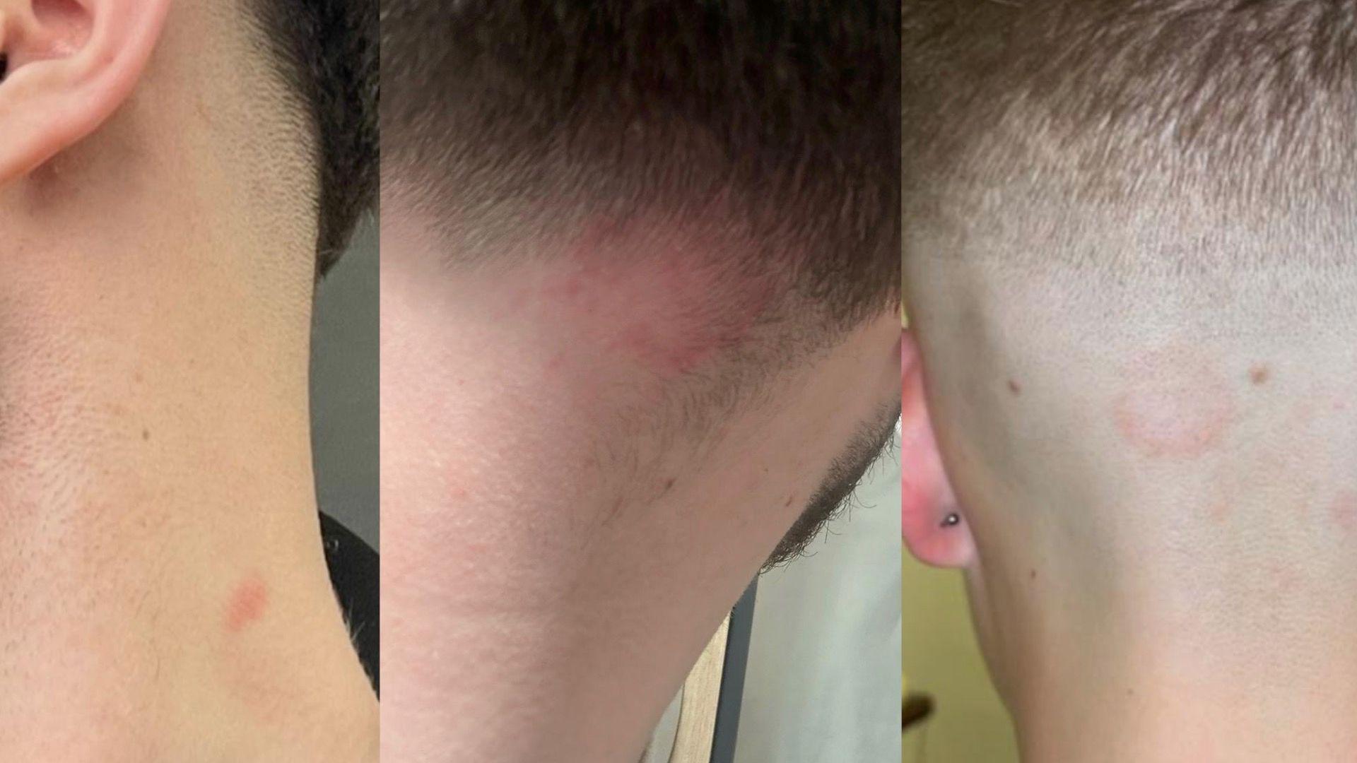 Three different images of mens heads. One from the side has a red spot on the side of the neck. One from behind has a red rash on the hairline and one from behind has a red circle on the back of the head