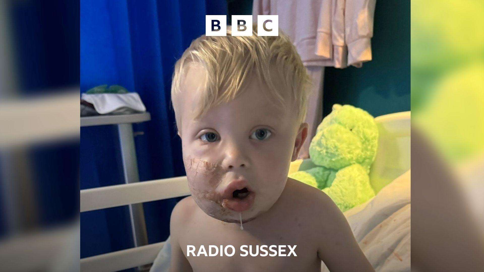 A toddler sits on a hospital bed. His right cheek is swollen and covered in dressings. There is a green soft toy on the bed behind him.