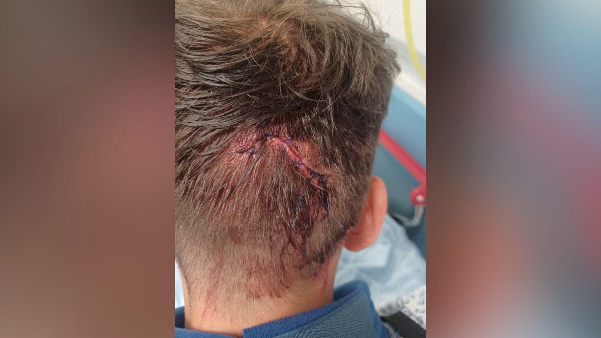 The back of someone's head with stitches and a long, bloody scar in the shape of a worm. 