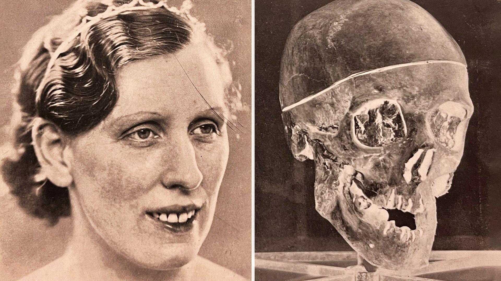 Compsite image showing Isabella Ruxton, who has short wavy hair, on the left and an X-ray of her skull on the right.