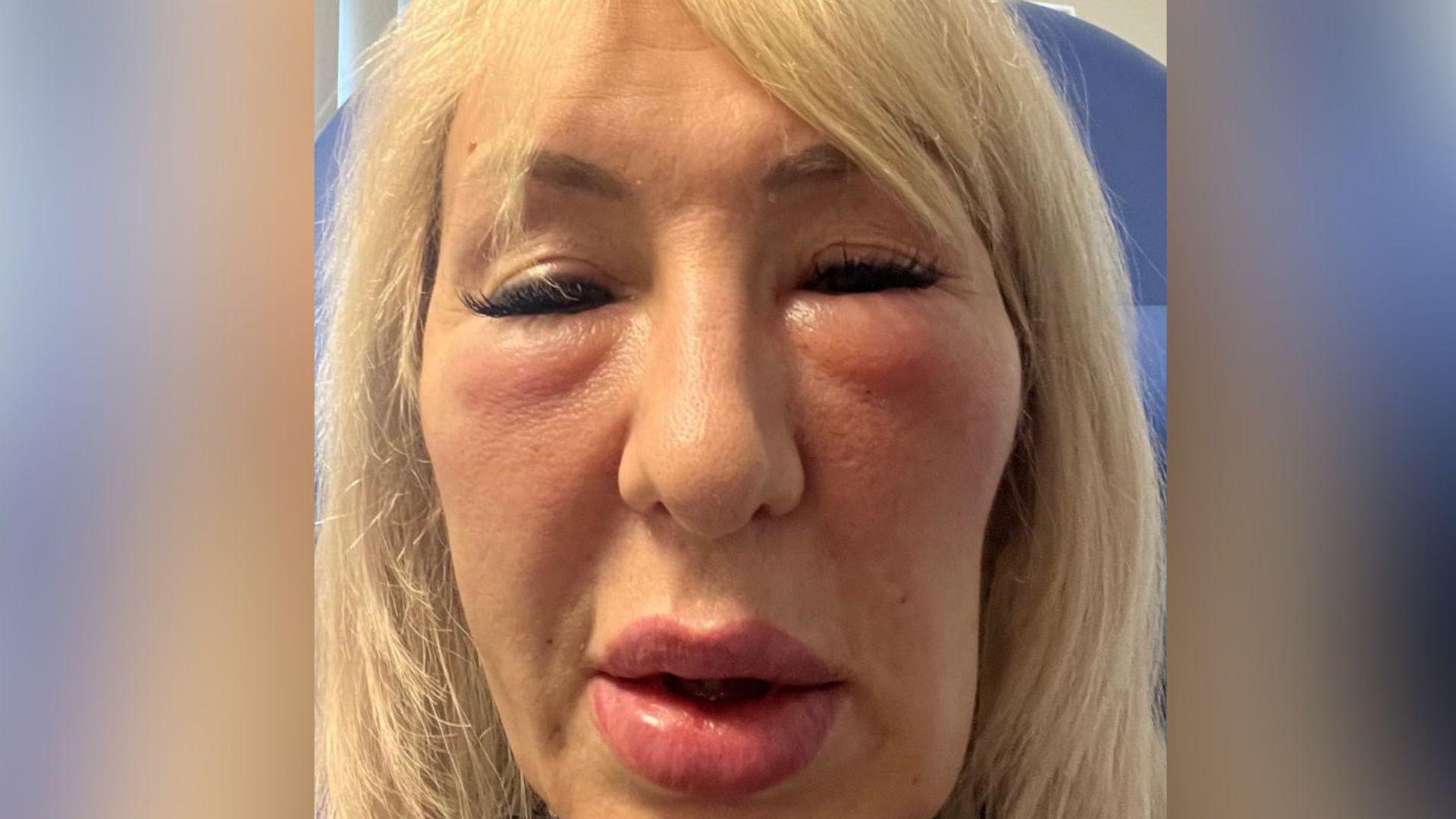 Andrea after her treatments. Her cheeks and lips are puffy and her eyes are barely open. She has shoulder-length blonde hair and is sitting in a blue medical chair