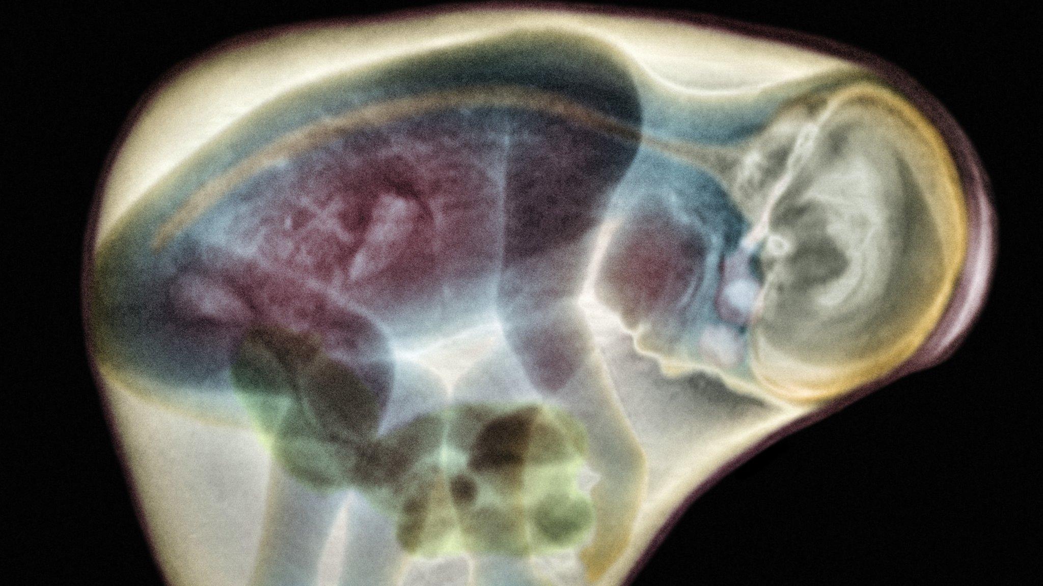 MRI of baby