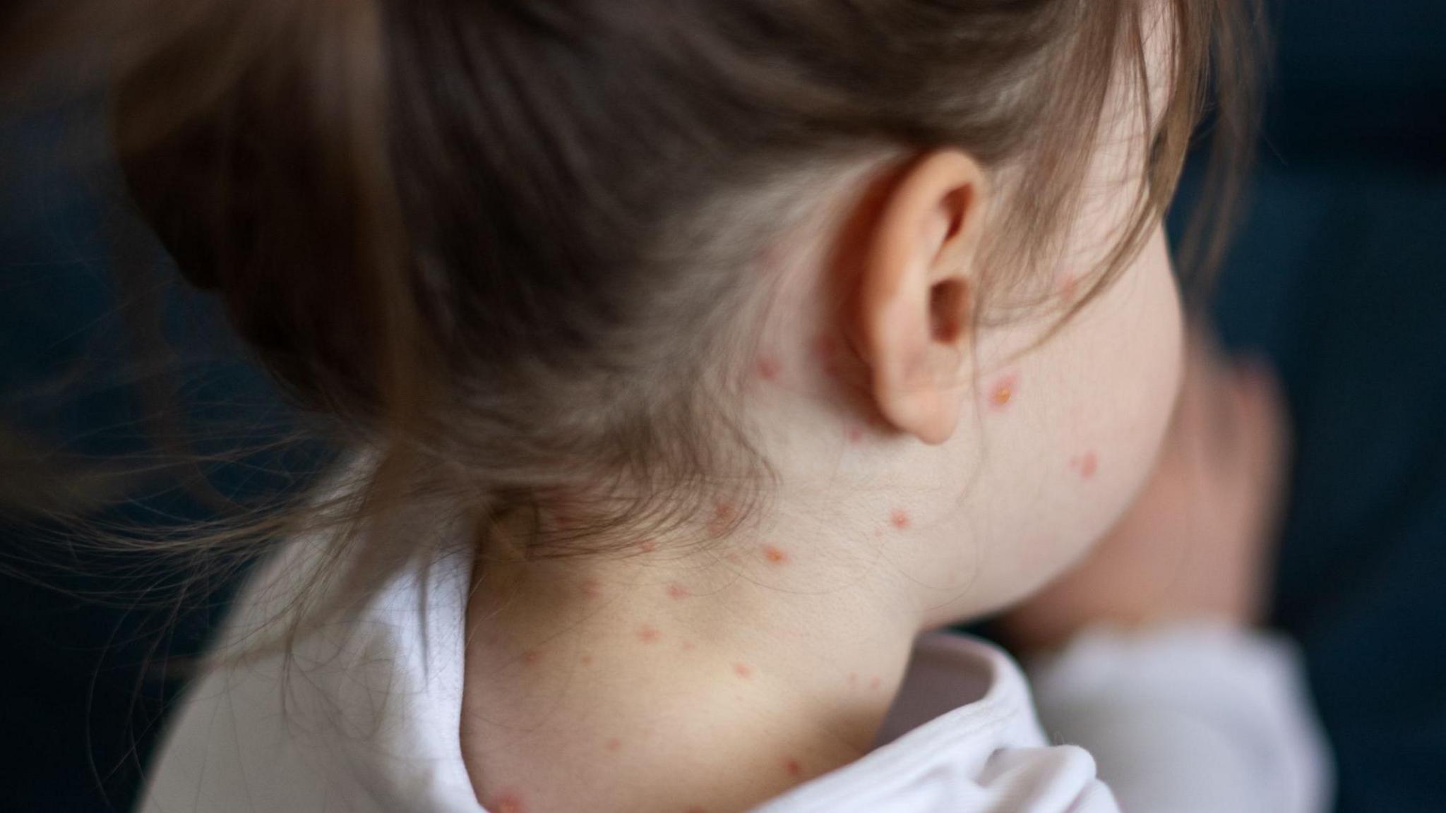 Close-up of a girl taken from the back of her head with chickenpox measles visible on her neck and face.