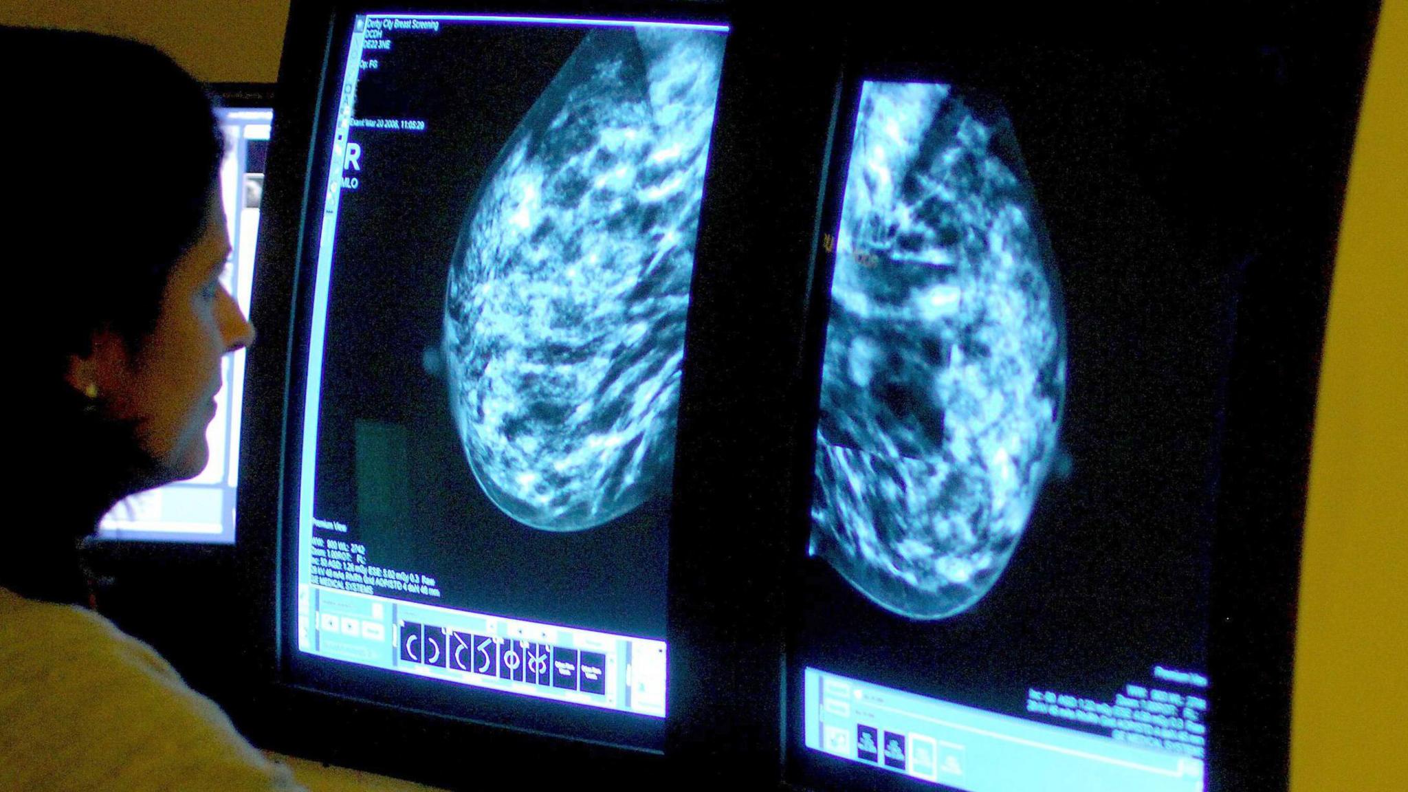 File photo of a consultant analysing a mammogram of a woman's breast in order check for breast cancer.