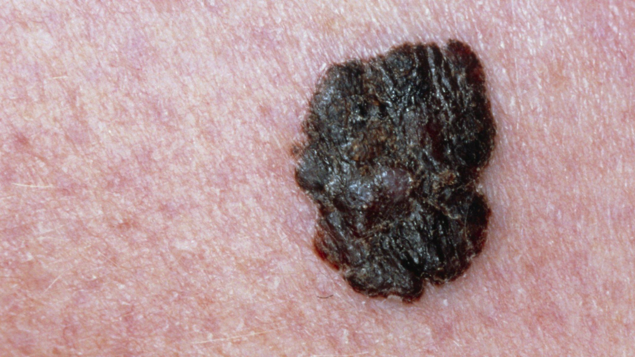 Skin cancer