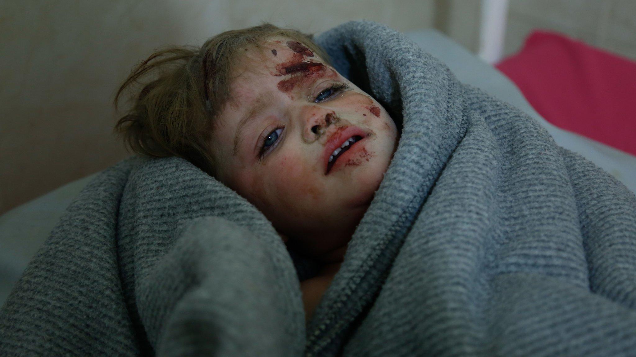 A Syrian child injured in an attack on the town of Misraba, in the Eastern Ghouta outside Damascus, receives treatment at a make-shift hospital in Douma (4 January 2018)