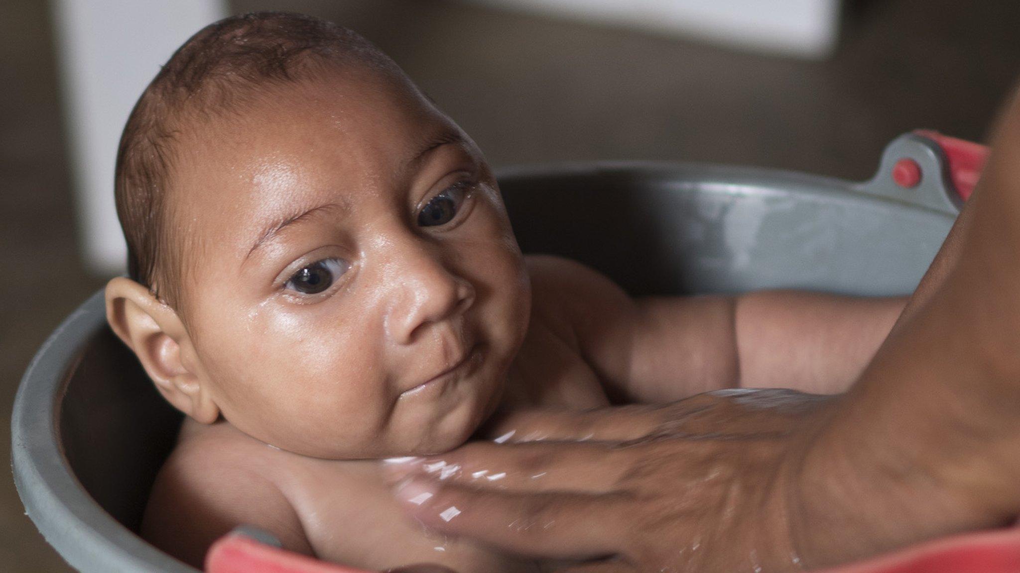 Baby with microcephaly