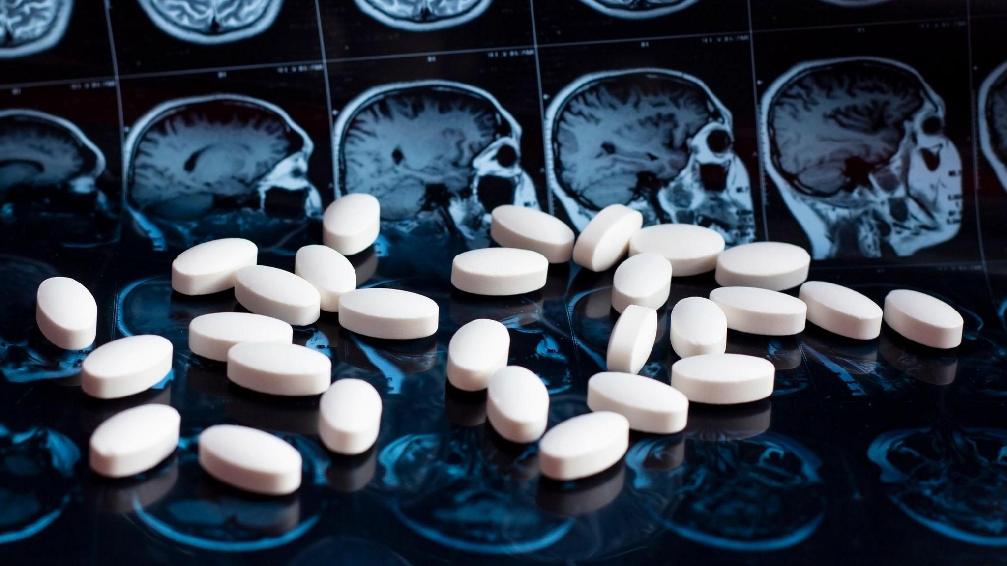 NHS will not fund new drug to slow Alzheimer’s