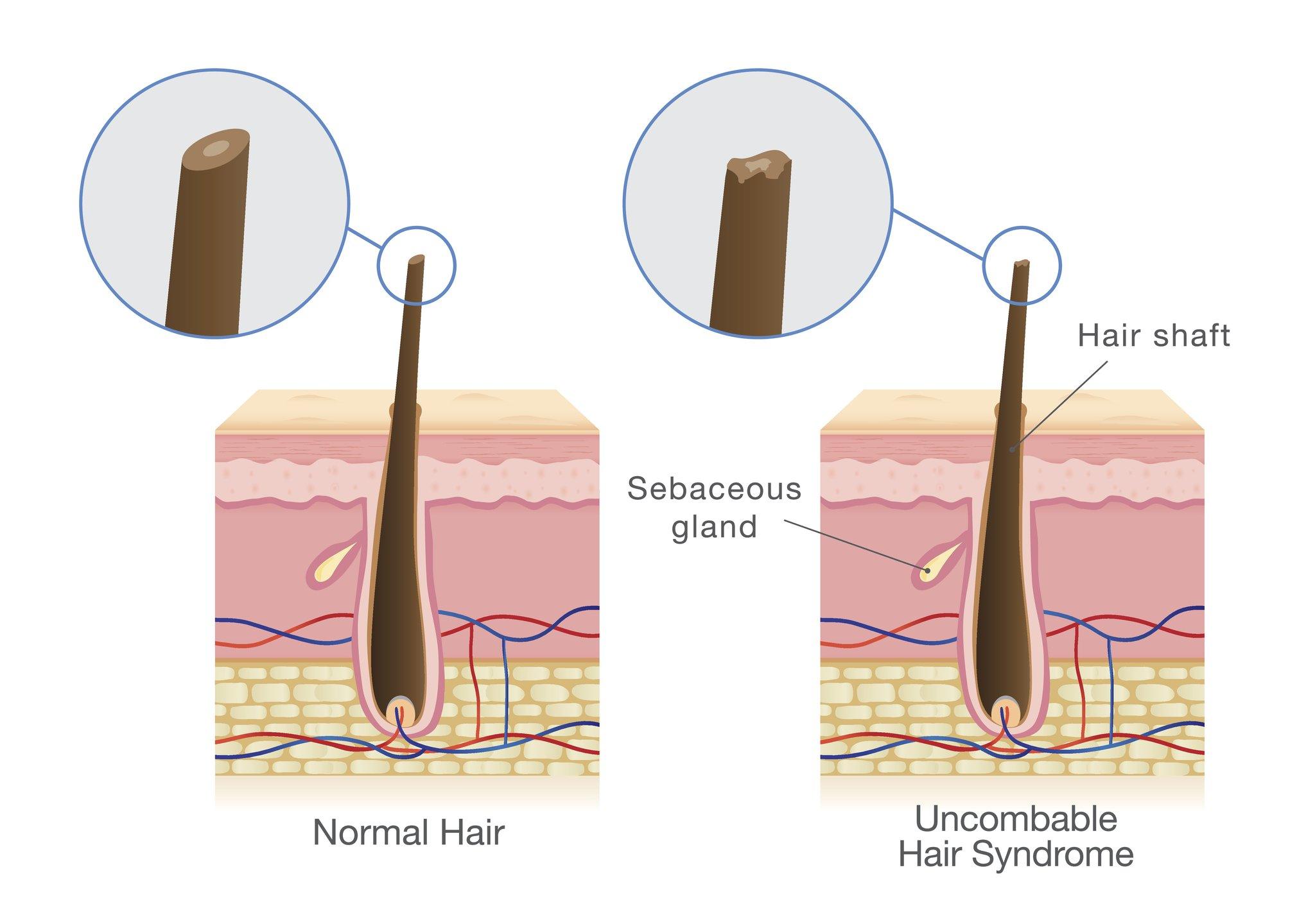 The difference between the hair shaft with and without unbombable hair syndrome. The normal hair strand is smooth. The hair strand with uncombable hair syndrome is more jagged.