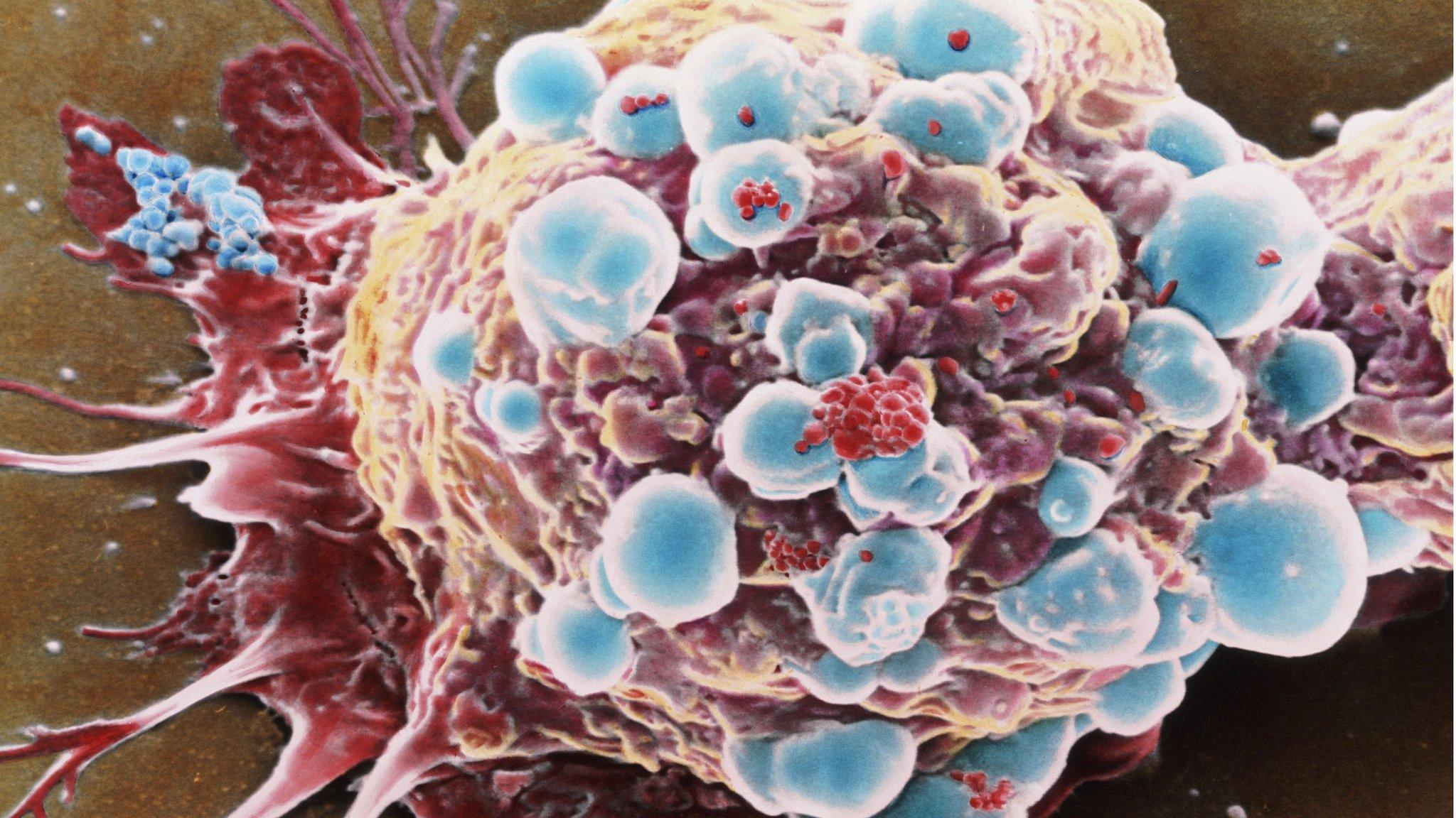 Breast cancer