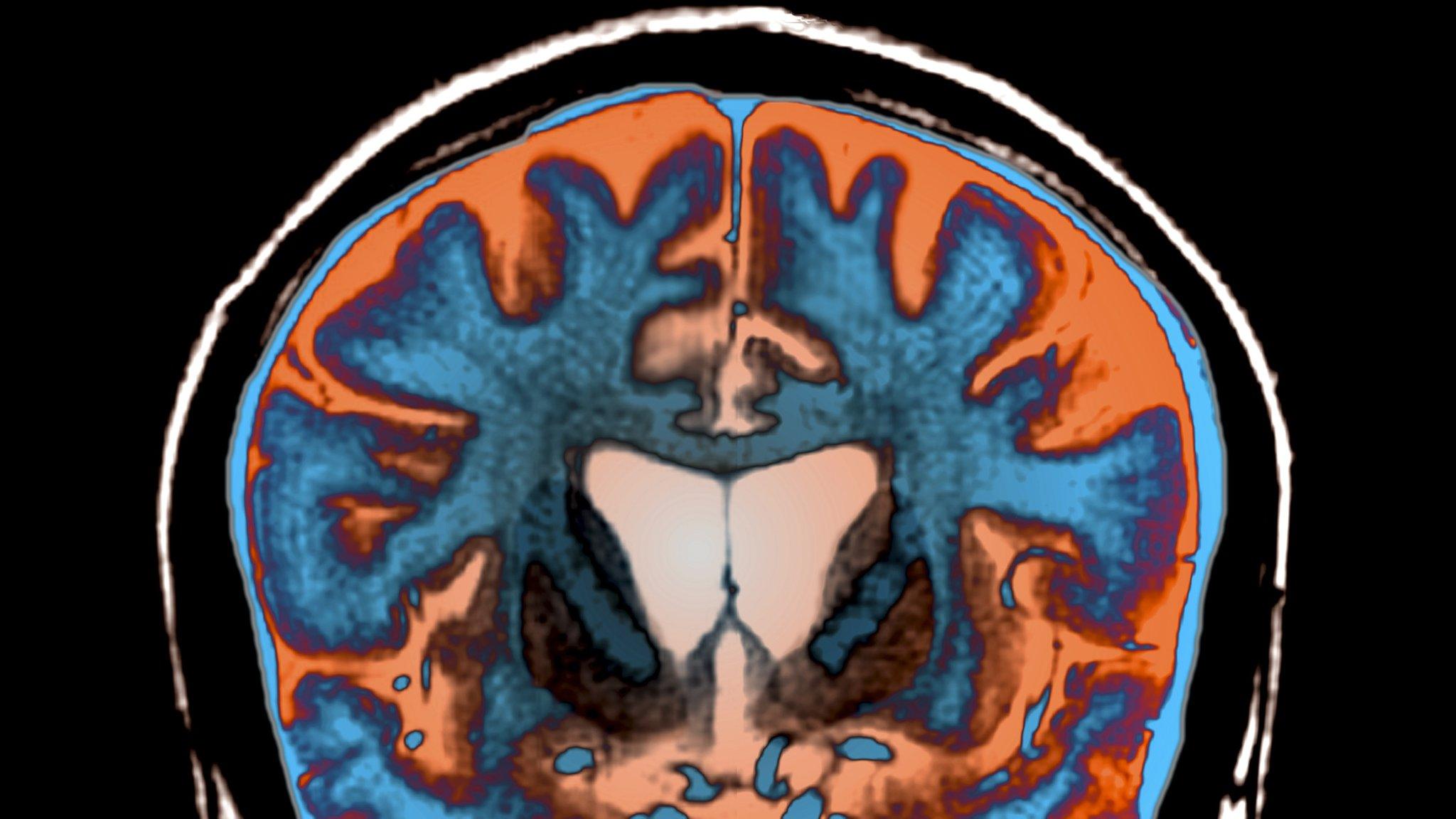 Brain scan