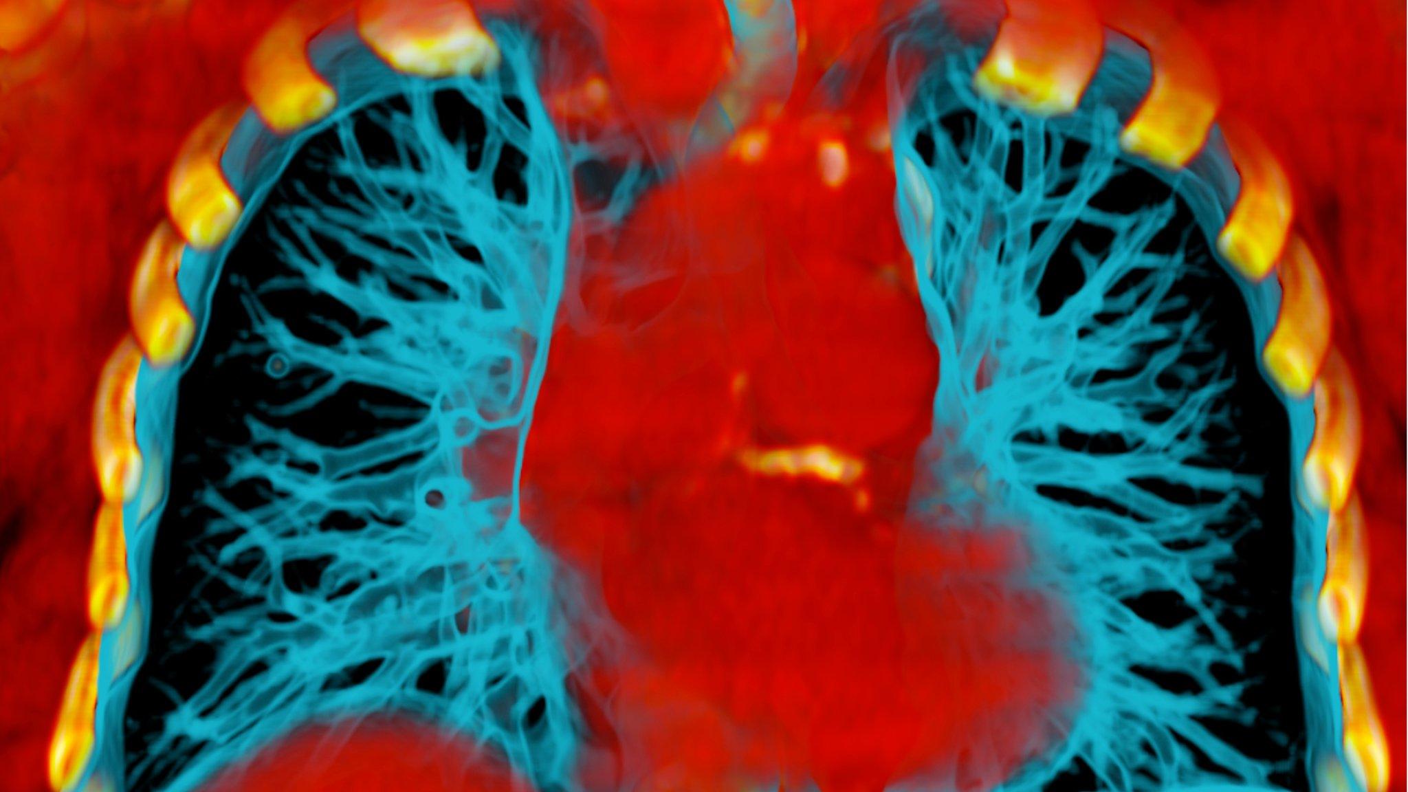 Lung