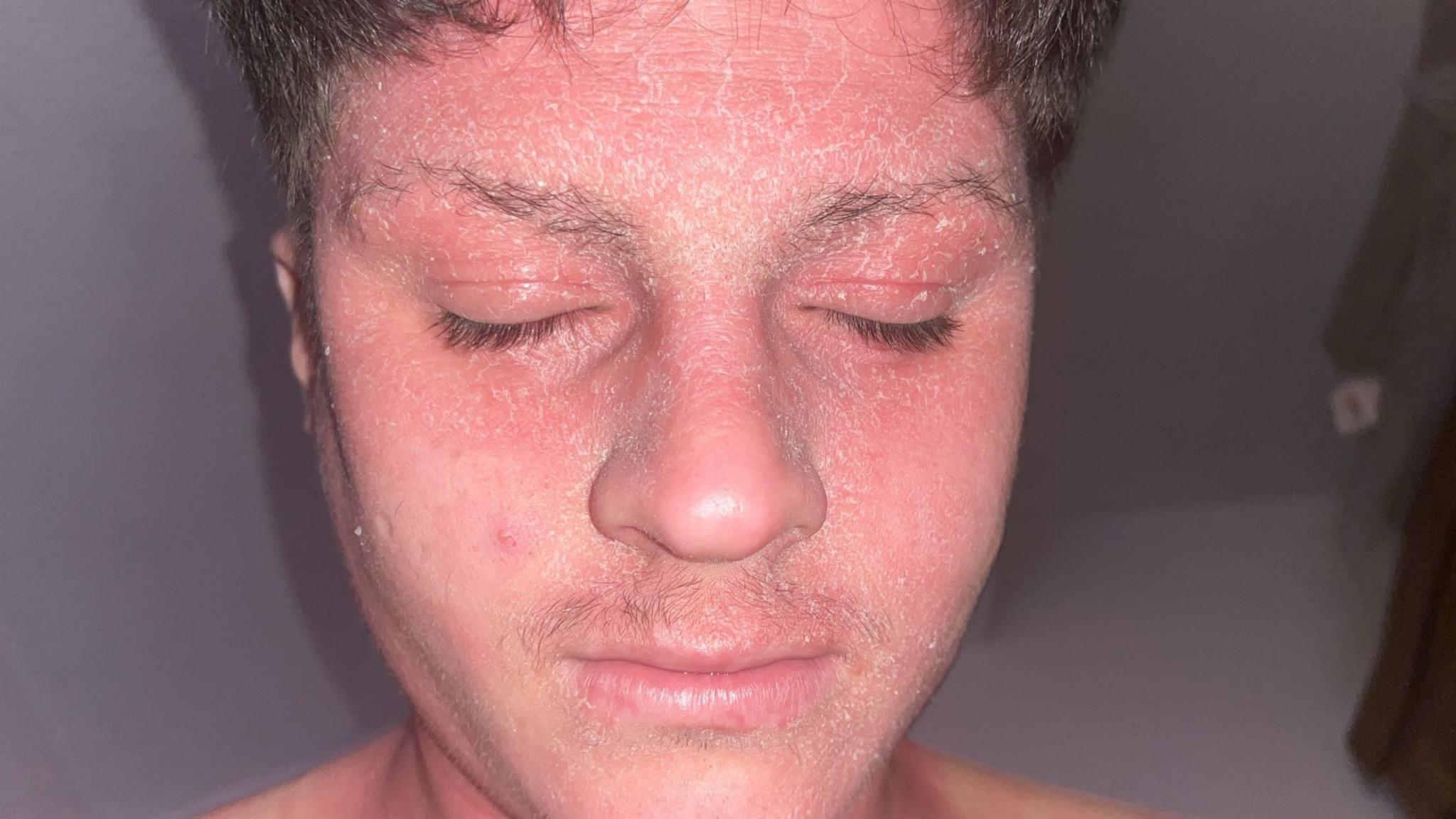 A close up of a brown haired man's face, with several dry, flakey patches of skin.